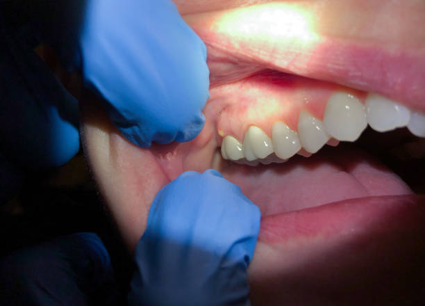 Best Emergency Dentist for Lost Fillings or Crowns in Larkspur, CA